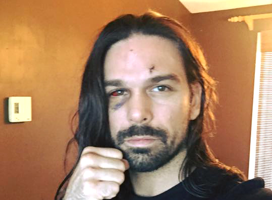 Le combattant sorelois a subi une fracture à un os près de l’œil. | Photo: tirée de Facebook
