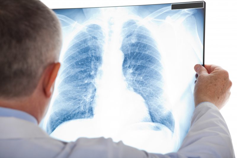 La cancer du poumon est relié à 85% du temps au tabagsime. | depositphotos.com
